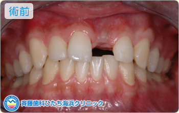 術前