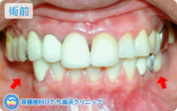 術前
