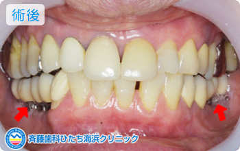 術後