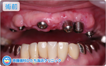 術前