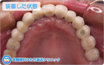 装着した状態